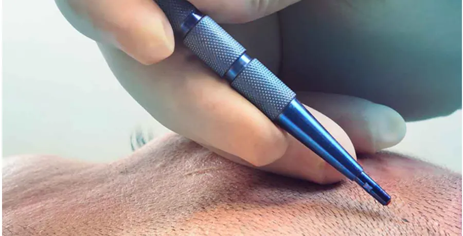 Bezbolestná Transplantácia Vlasov