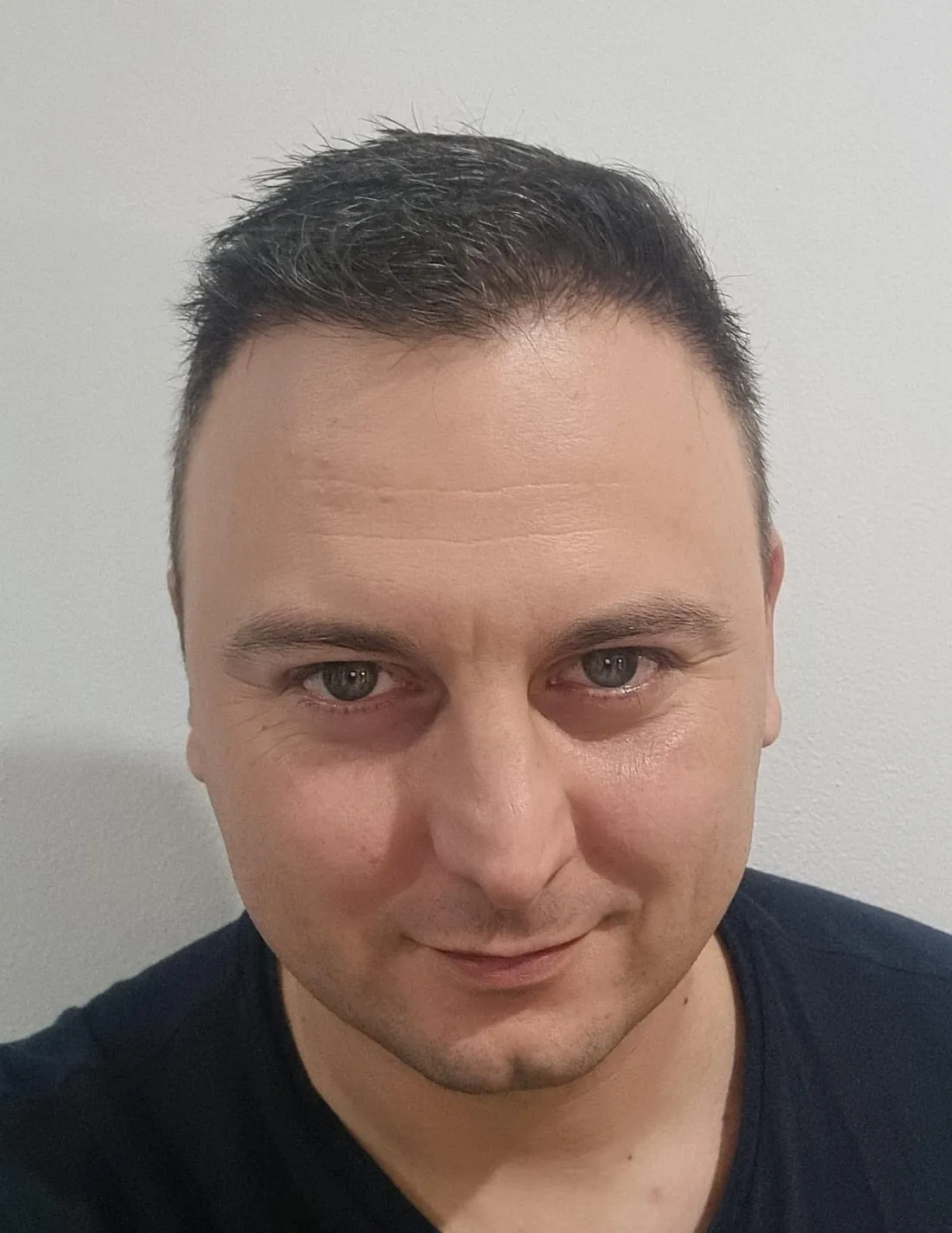 Ten istý klient po transplantácii vlasov